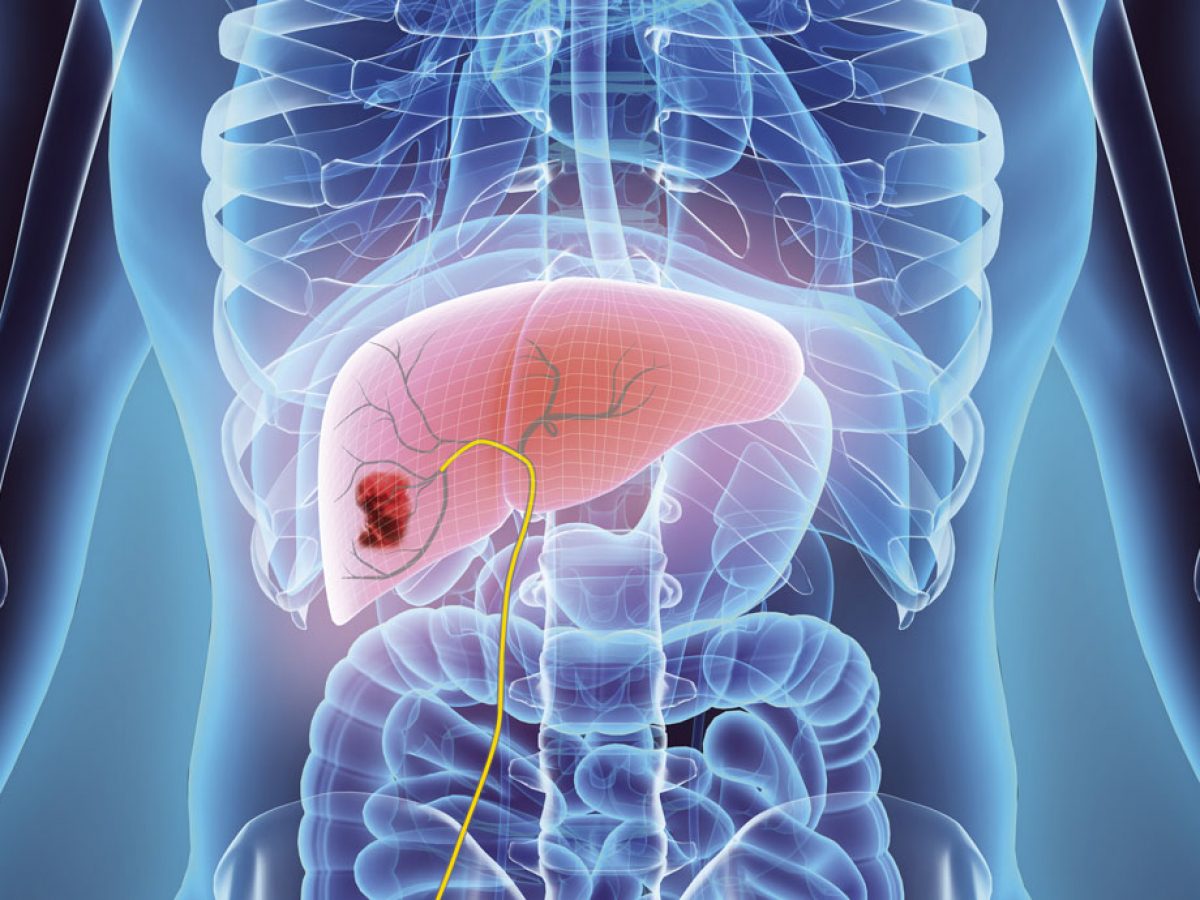 liver cancer treatment